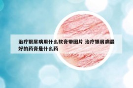 治疗银屑病用什么软膏带图片 治疗银屑病最好的药膏是什么药