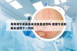 哥哥得牛皮癣弟弟没有是遗传吗 爸爸牛皮肤癣会遗传下一代吗