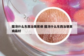 醋泡什么东西治银屑病 醋泡什么东西治银屑病最好