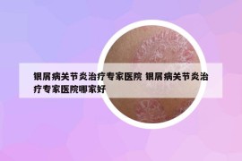 银屑病关节炎治疗专家医院 银屑病关节炎治疗专家医院哪家好