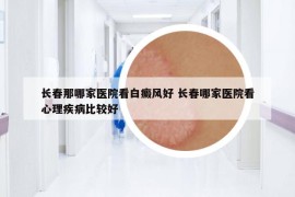 长春那哪家医院看白癜风好 长春哪家医院看心理疾病比较好