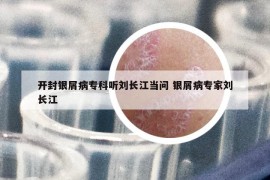 开封银屑病专科听刘长江当问 银屑病专家刘长江