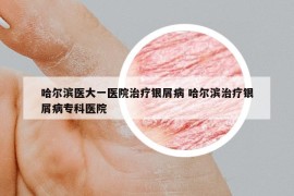 哈尔滨医大一医院治疗银屑病 哈尔滨治疗银屑病专科医院