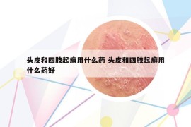 头皮和四肢起癣用什么药 头皮和四肢起癣用什么药好