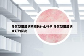 寻常型银屑病初期长什么样子 寻常型银屑病变好的征兆