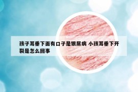 孩子耳垂下面有口子是银屑病 小孩耳垂下开裂是怎么回事