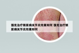 强克治疗银屑病关节炎效果如何 强克治疗银屑病关节炎效果如何