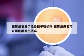 银屑病复发了能给孩子喂奶吗 银屑病患者可以母乳喂养小孩吗