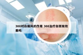 308对白癜风的作用 308治疗白斑有效果吗