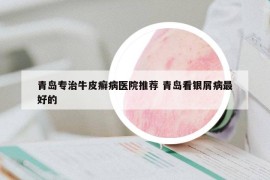 青岛专治牛皮癣病医院推荐 青岛看银屑病最好的