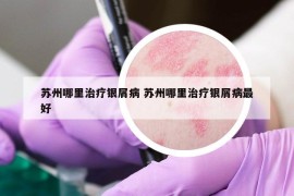 苏州哪里治疗银屑病 苏州哪里治疗银屑病最好