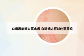 白癜风能喝白蒿水吗 白斑病人可以吃茼蒿吗