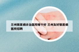 兰州银屑病诊治医院哪个好 兰州友好银屑病医院招聘