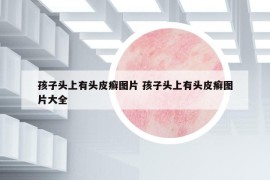 孩子头上有头皮癣图片 孩子头上有头皮癣图片大全