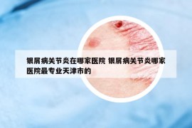 银屑病关节炎在哪家医院 银屑病关节炎哪家医院最专业天津市的