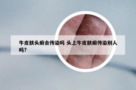 牛皮肤头癣会传染吗 头上牛皮肤癣传染别人吗?