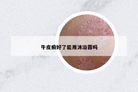 牛皮癣好了能用沐浴露吗