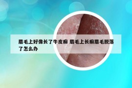 眉毛上好像长了牛皮癣 眉毛上长癣眉毛脱落了怎么办