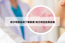 蚊子咬抓后成了银屑病 蚊子咬完后像皮癣