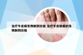 治疗牛皮癣生物制剂价格 治疗牛皮肤癣的生物制剂价格