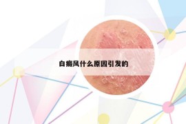 白癜风什么原因引发的