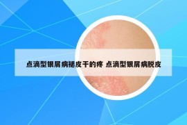 点滴型银屑病褪皮干的疼 点滴型银屑病脱皮