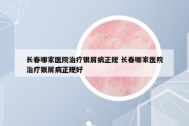 长春哪家医院治疗银屑病正规 长春哪家医院治疗银屑病正规好