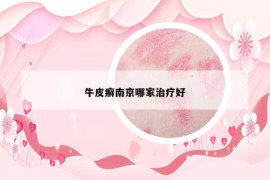 牛皮癣南京哪家治疗好