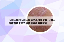 卡泊三醇和卡泊三醇倍他米松哪个好 卡泊三醇搽剂和卡泊三醇倍他米松凝胶区别