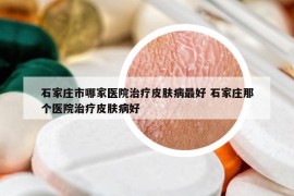 石家庄市哪家医院治疗皮肤病最好 石家庄那个医院治疗皮肤病好