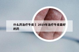 什么药治疗牛皮廯 2019年治疗牛皮最好的药