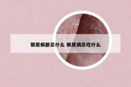 银屑癣都忌什么 银屑病忌吃什么