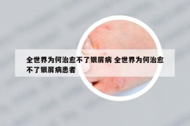 全世界为何治愈不了银屑病 全世界为何治愈不了银屑病患者