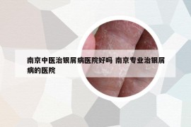 南京中医治银屑病医院好吗 南京专业治银屑病的医院