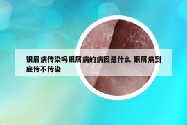 银屑病传染吗银屑病的病因是什么 银屑病到底传不传染