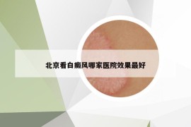 北京看白癜风哪家医院效果最好