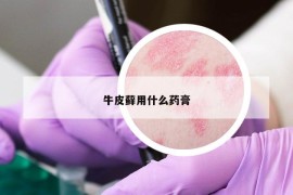 牛皮藓用什么药膏