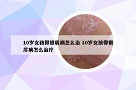 10岁女孩得银屑病怎么治 10岁女孩得银屑病怎么治疗