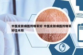 中医皮肤病医院哪家好 中医皮肤病医院哪家好佳木斯