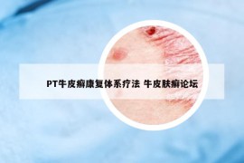 PT牛皮癣康复体系疗法 牛皮肤癣论坛