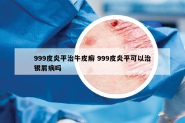 999皮炎平治牛皮癣 999皮炎平可以治银屑病吗