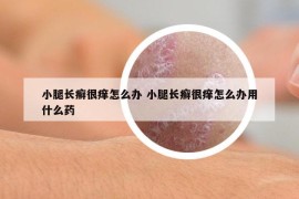 小腿长癣很痒怎么办 小腿长癣很痒怎么办用什么药