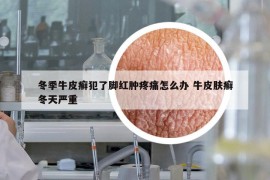 冬季牛皮癣犯了脚红肿疼痛怎么办 牛皮肤癣冬天严重