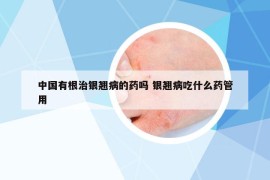 中国有根治银翘病的药吗 银翘病吃什么药管用