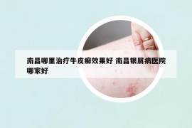 南昌哪里治疗牛皮癣效果好 南昌银屑病医院哪家好