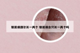 银屑病偶尔长一两个 银屑病会只长一两个吗