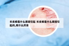 长皮癣是什么原因引起 长皮癣是什么原因引起的,用什么药膏