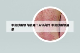 牛皮肤癣银肖病用什么软高好 牛皮肤癣银屑病