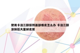 使用卡泊三醇搽剂面部爆皮怎么办 卡泊三醇涂抹后大量掉皮屑