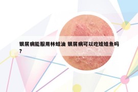 银屑病能服用林蛙油 银屑病可以吃娃娃鱼吗?